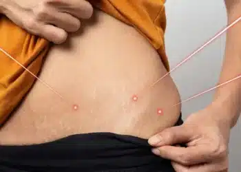 After-delivery Stretch Marks