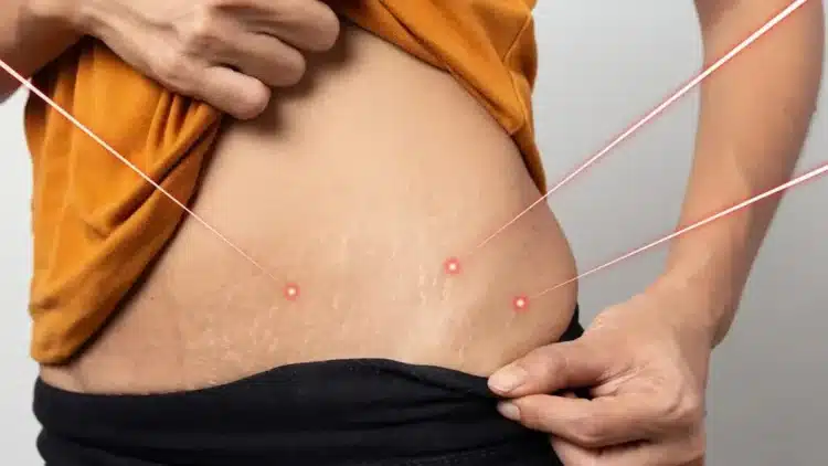 After-delivery Stretch Marks